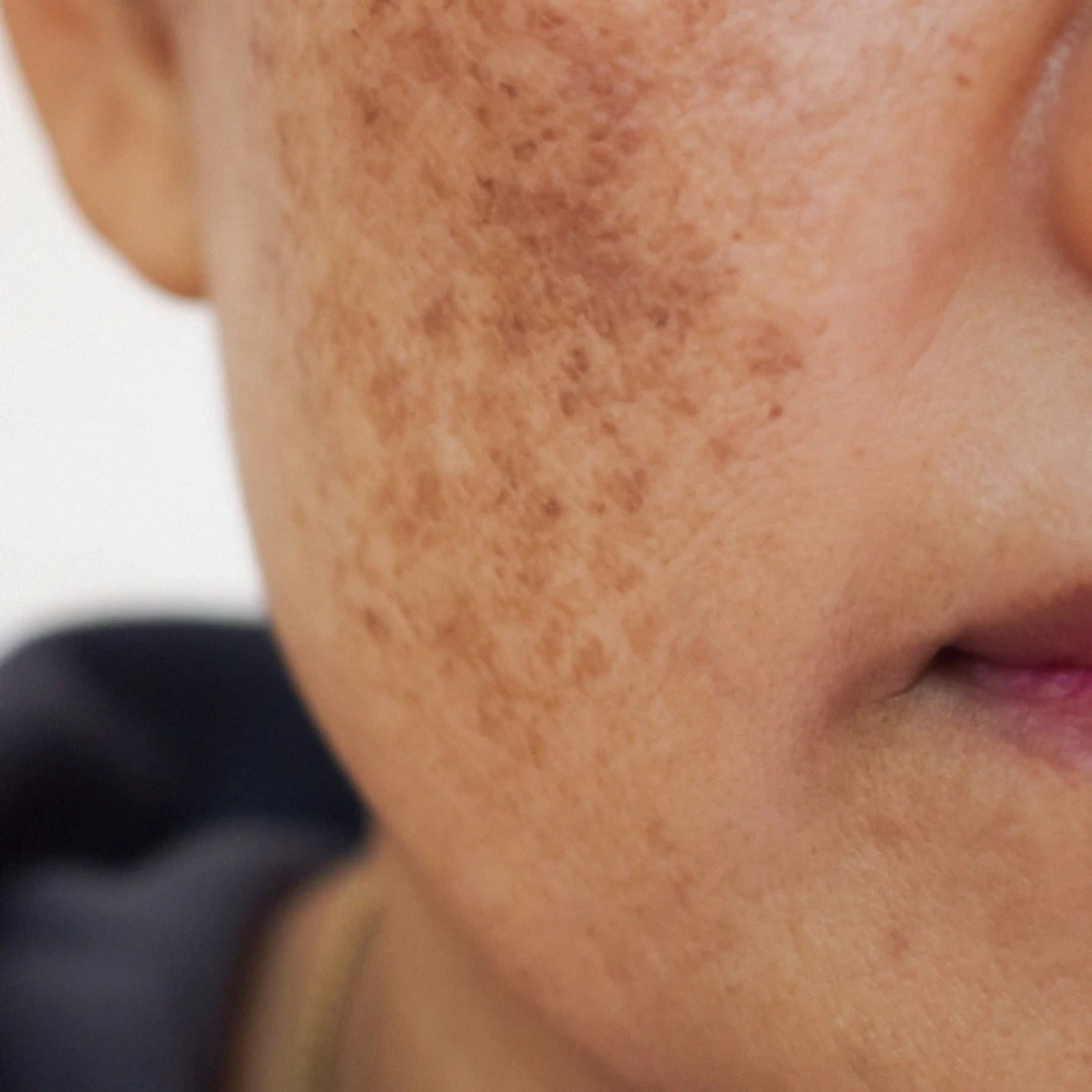 Melasma